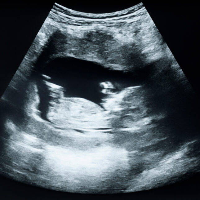 Fetal ultrasound